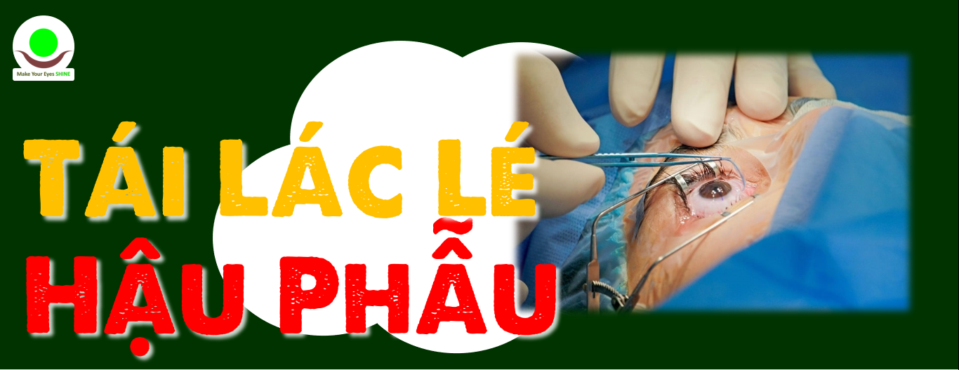 Tại Sao Mổ Mắt Lác (Mắt Lé) Thường Không Dứt Điểm và Hay Bị Tái Phát?