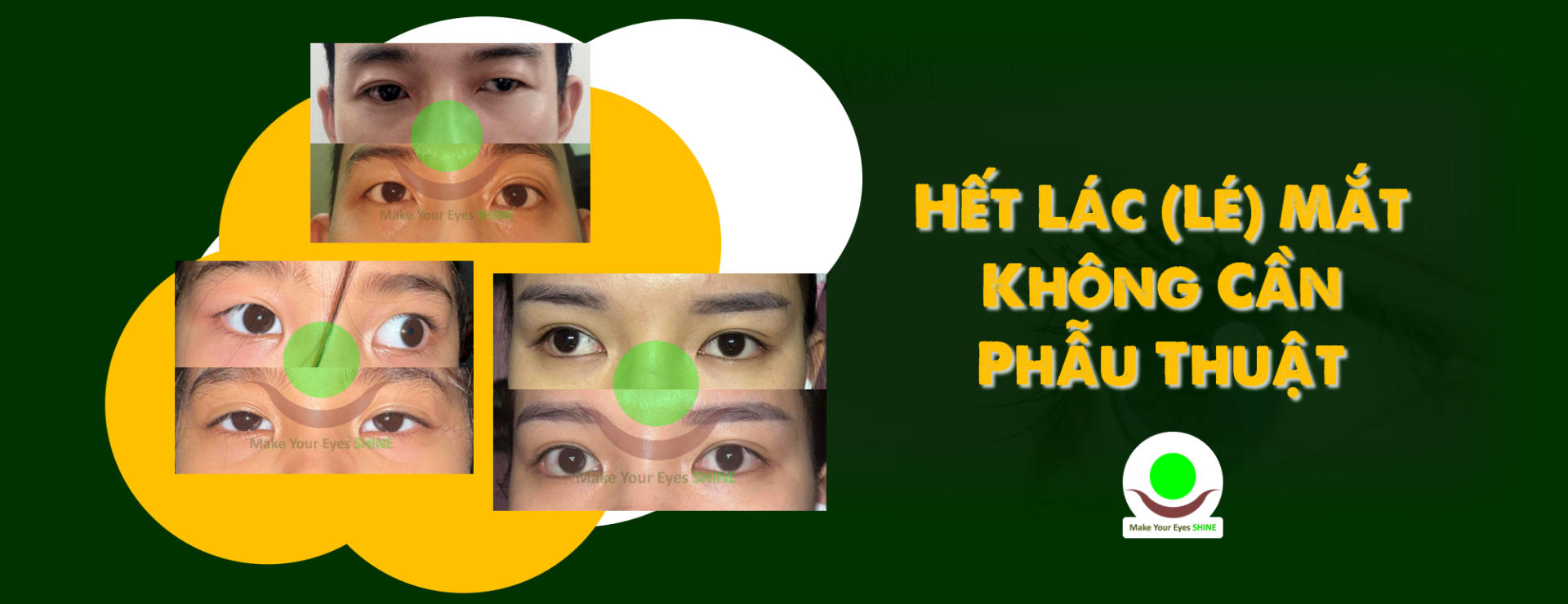 Nguyên nhân, Cách chữa Lác và Phương pháp Điều trị Hiệu quả